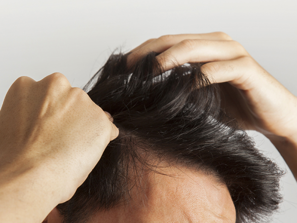 Véletlenül fedezték fel a tudósok a kopaszodás ellenszerét! Hatékony megoldás lehet a hajhullás kezelésére
